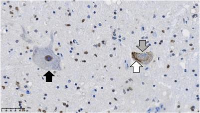 Proteinopathies as Hallmarks of Impaired Gene Expression, Proteostasis and Mitochondrial Function in Amyotrophic Lateral Sclerosis